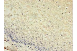 Immunohistochemistry of paraffin-embedded human cervical cancer using ABIN7153613 at dilution of 1:100 (Connexin 31 抗体  (AA 211-270))