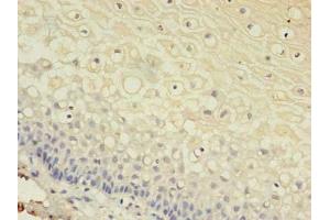 Immunohistochemistry of paraffin-embedded human cervical cancer using ABIN7153613 at dilution of 1:100 (Connexin 31 抗体  (AA 211-270))