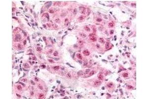 Affinity Purified anti- E2F-1 pS364 antibody was used at a 10 µg/ml to detect nuclear and occasion-ally cytoplasmic signal in a variety of tissues in-cluding multi-human, multi-brain and multi-cancer slides. (E2F1 抗体  (pSer364))