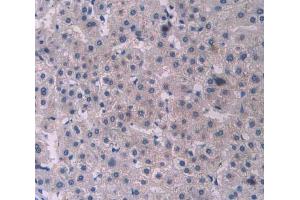 IHC-P analysis of liver cancer tissue, with DAB staining. (PCOLCE 抗体  (AA 315-437))