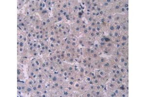 IHC-P analysis of liver cancer tissue, with DAB staining.