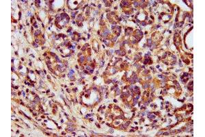 IHC image of ABIN7159577 diluted at 1:400 and staining in paraffin-embedded human pancreatic cancer performed on a Leica BondTM system. (METAP1 抗体  (AA 54-125))