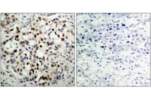 Immunohistochemistry analysis of paraffin-embedded human breast carcinoma, using CREB (Phospho-Ser133) Antibody. (CREB1 抗体  (pSer133))