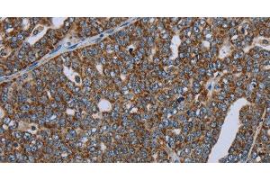 Immunohistochemistry of paraffin-embedded Human ovarian cancer using NDUFA13 Polyclonal Antibody at dilution of 1:50 (NDUFA13 抗体)