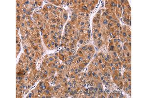 Immunohistochemistry of Human gastric cancer using EFNA5 Polyclonal Antibody at dilution of 1:40 (Ephrin A5 抗体)