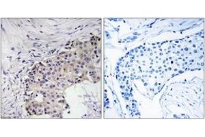 Immunohistochemistry analysis of paraffin-embedded human breast carcinoma, using SCARF2 Antibody. (SCARF2 抗体  (AA 677-726))