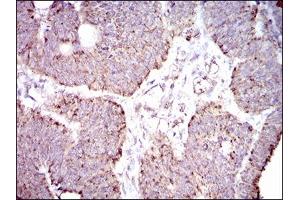Immunohistochemical analysis of paraffin-embedded rectum cancer tissues using ALDH2 mouse mAb with DAB staining. (ALDH2 抗体  (AA 317-517))