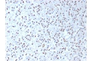 Formalin-fixed, paraffin-embedded human Mesothelioma stained with Wilm's Tumor Rabbit Recombinant Monoclonal Antibody (WT1/1434R). (Recombinant WT1 抗体)