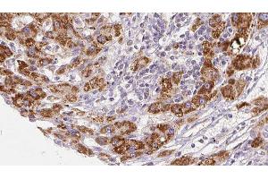 ABIN6277936 at 1/100 staining Human liver cancer tissue by IHC-P. (PNPLA2 抗体  (Internal Region))