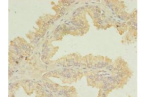 Immunohistochemistry of paraffin-embedded human prostate cancer using ABIN7174434 at dilution of 1:100 (UBE2D1 抗体  (AA 1-147))