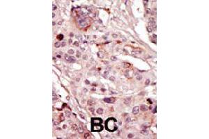 Formalin-fixed and paraffin-embedded human cancer tissue reacted with SRMS polyclonal antibody  , which was peroxidase-conjugated to the secondary antibody, followed by AEC staining.