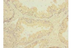 Immunohistochemistry of paraffin-embedded human prostate cancer using ABIN7168448 at dilution of 1:100 (RGR 抗体  (AA 152-291))