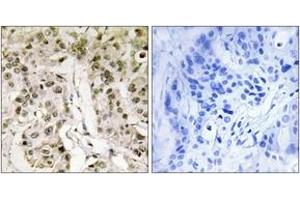 Immunohistochemistry analysis of paraffin-embedded human breast carcinoma tissue, using HCFC1 Antibody. (HCFC1 抗体  (AA 131-180))