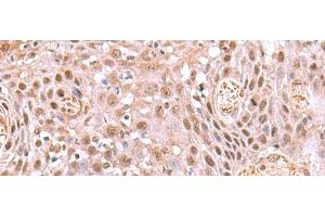 Immunohistochemistry of paraffin-embedded Human tonsil tissue using DDI2 Polyclonal Antibody at dilution of 1:75(x200) (DDI2 抗体)