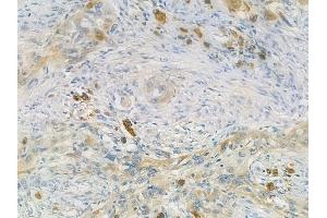 ABIN6264095 and ABIN6273290 at 1/100 staining human tongue carcinoma by IHC-P.