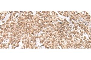 Immunohistochemistry of paraffin-embedded Human ovarian cancer tissue using ZNF560 Polyclonal Antibody at dilution of 1:25(x200) (ZNF560 抗体)