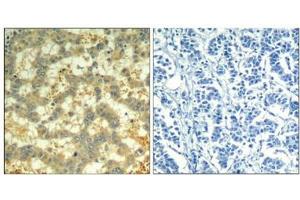 Immunohistochemical analysis of paraffin-embedded human breast carcinoma tissue using syk(Phospho-Tyr323) Antibody(left) or the same antibody preincubated with blocking peptide(right). (SYK 抗体  (pTyr323))
