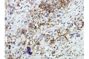 IHC-P Image Immunohistochemical analysis of paraffin-embedded Human pancreatic tumor, using CD44, antibody at 1:100 dilution. (CD44 抗体)