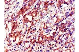 Immunohistochemistry of paraffin-embedded human gastric cancer using ABIN7156360 at dilution of 1:100 (IGF2BP3 抗体  (AA 1-100))