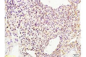 Formalin-fixed and human breast carcinoma tissue labeled with Anti-phospho-BACH1/BRIP1(Ser990) Polyclonal Antibody, Unconjugated  at 1:200 followed by conjugation to the secondary antibody and DAB staining (BRIP1 抗体  (pSer990))