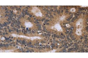 Immunohistochemistry of paraffin-embedded Human colon cancer tissue using FGFR1OP2 Polyclonal Antibody at dilution 1:40 (FGFR1OP2 抗体)