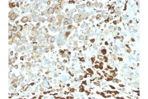 Formalin-fixed, paraffin-embedded human Melanoma stained with NGFR Rabbit Recombinant Monoclonal Antibody (NGFR/2550R). (Recombinant NGFR 抗体  (AA 281-421))