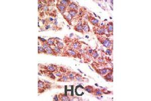 Formalin-fixed and paraffin-embedded human hepatocellular carcinoma tissue reacted with USP12 polyclonal antibody  , which was peroxidase-conjugated to the secondary antibody, followed by AEC staining . (USP12 抗体  (N-Term))