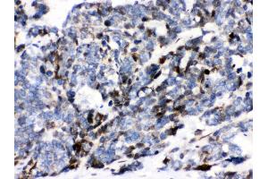 Anti- Ataxin 1 Picoband antibody, IHC(P) IHC(P): Human Lung Cancer Tissue (Ataxin 1 抗体  (C-Term))