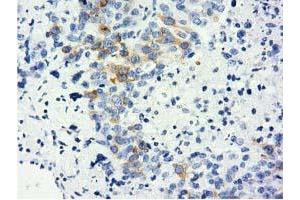 Immunohistochemical staining of paraffin-embedded Adenocarcinoma of Human ovary tissue using anti-LIN7B mouse monoclonal antibody. (LIN7B 抗体)