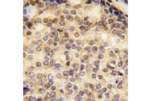 IHC analysis of FFPE human prostate carcinoma tissue stained with SOX9 antibody (SOX9 抗体  (AA 41-70))