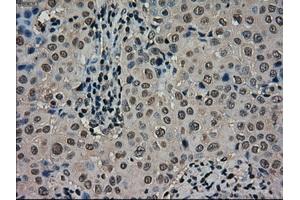 Immunohistochemical staining of paraffin-embedded Carcinoma of thyroid tissue using anti-SCYL3mouse monoclonal antibody. (SCYL3 抗体)