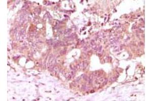 Immunohistochemical analysis of paraffin-embedded human recturn adenocarcinoma tissue showing cytoplasmic localization using FGF2 monoclonal antibody, clone 2H5G2C11  with DAB staining. (FGF2 抗体)