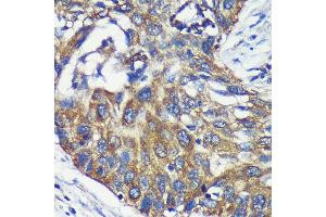 Immunohistochemistry of paraffin-embedded Human lung cancer using L Rabbit pAb (ABIN7265386) at dilution of 1:100 (40x lens). (ARPC5L 抗体  (AA 1-100))