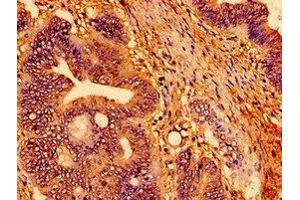 Immunohistochemistry of paraffin-embedded human colon cancer using ABIN7166747 at dilution of 1:100