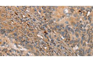 Immunohistochemistry of paraffin-embedded Human cervical cancer tissue using HK3 Polyclonal Antibody at dilution 1:40 (HK3 抗体)