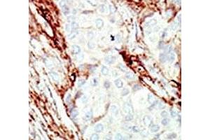 IHC analysis of FFPE human breast carcinoma tissue stained with the FGFR1 antibody (FGFR1 抗体  (AA 19-48))