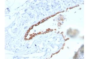 Formalin-fixed, paraffin-embedded human Lung Mesothelioma stained with Mesothelin Mouse Monoclonal Antibody (MSLN/3384). (Mesothelin 抗体  (AA 273-407))