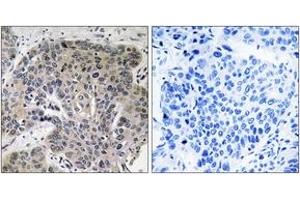 Immunohistochemistry analysis of paraffin-embedded human lung carcinoma tissue, using S100A3 Antibody. (S100A3 抗体  (AA 26-75))