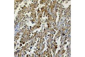 Immunohistochemical analysis of Carbonic Anhydrase 9 staining in human lung cancer formalin fixed paraffin embedded tissue section. (CA9 抗体)