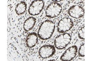 ABIN6267309 at 1/200 staining human colon cancer tissue sections by IHC-P. (C-JUN 抗体  (pSer73))