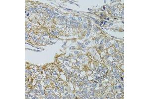 Immunohistochemistry of paraffin-embedded human gastric cancer using CHMP4B antibody. (CHMP4B 抗体  (AA 1-224))