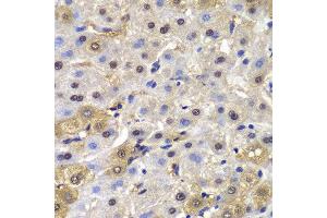 Immunohistochemistry of paraffin-embedded human liver cancer using MAD1L1 antibody at dilution of 1:100 (400x lens). (MAD1L1 抗体)