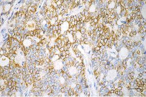 Immunohistochemistry was performed on paraffin-embedded human prostatic adenocarcinoma using catenin delta 1 antibody (ABIN7797934), 1:200).