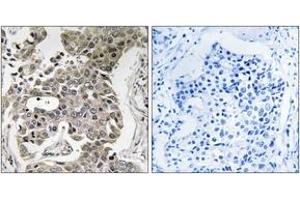 Immunohistochemistry analysis of paraffin-embedded human breast carcinoma tissue, using PPP2R1B Antibody. (PPP2R1B 抗体  (AA 552-601))