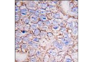 Formalin-fixed and paraffin-embedded human breast carcinoma tissue reacted with ERK8 antibody (N-term), which was peroxidase-conjugated to the secondary antibody, followed by DAB staining. (MAPK15 抗体  (N-Term))