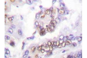 Immunohistochemistry analyzes of AML1 antibody in paraffin-embedded human lung carcinoma tissue. (RUNX1 抗体)