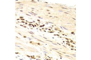 Immunohistochemistry of paraffin-embedded human gastric cancer using PRPF3 Antibody. (PRPF3 抗体  (AA 1-280))