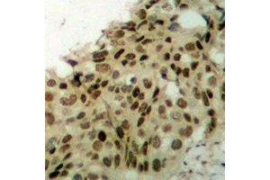 Immunohistochemical analysis of APTX staining in human breast cancer formalin fixed paraffin embedded tissue section. (Aprataxin 抗体)
