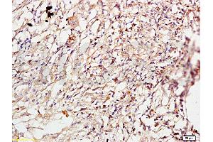 Formalin-fixed and paraffin embedded human lung carcinoma labeled with Anti-ROCK1 Polyclonal Antibody, Unconjugated (ABIN738636) at 1:200 followed by conjugation to the secondary antibody and DAB staining.