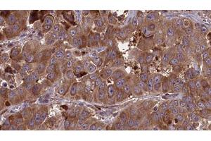 ABIN6273681 at 1/100 staining Human liver cancer tissue by IHC-P. (JAML 抗体  (C-Term))